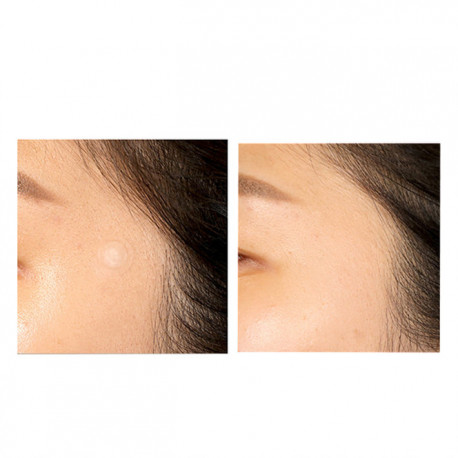 Some By Mi, Патчи против акне 30 Days Miracle Clear Spot Patch