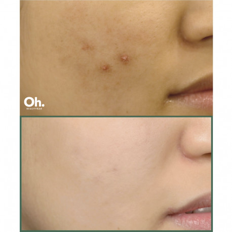 SOME BY MI 30 DAYS MIRACLE TEA TREE CLEAR SPOT OIL